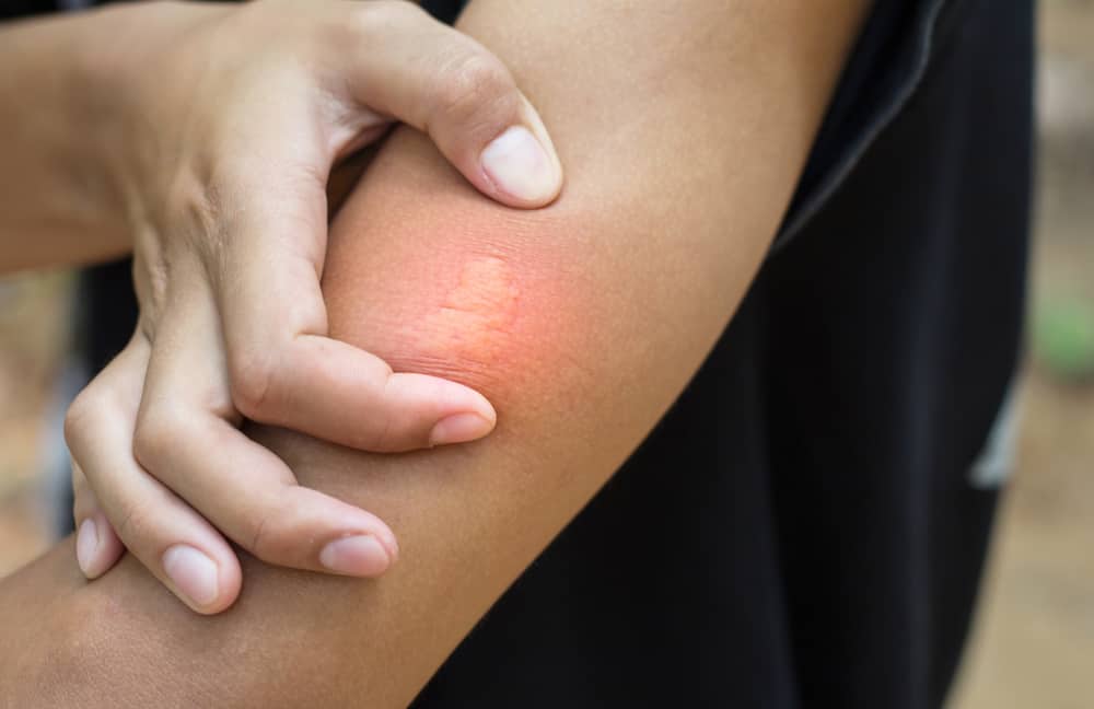 vết ong đốt bị ngứa phải làm sao