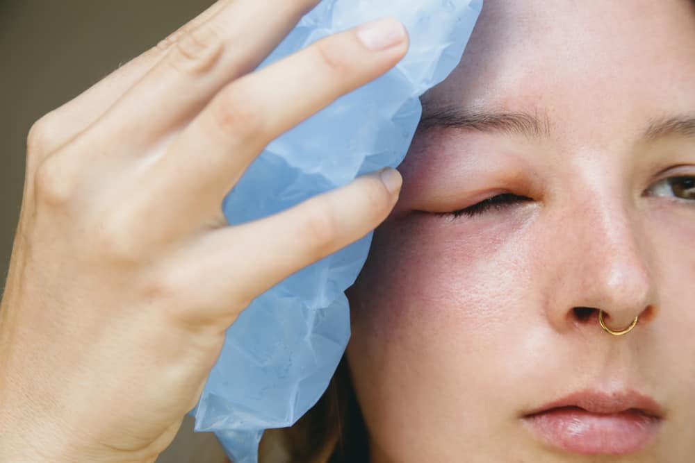 vết ong đốt bị ngứa phải làm sao: chườm lạnh