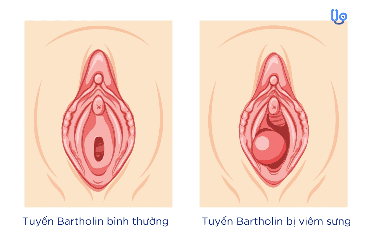 viem-tuyen-bartholin Viêm tuyến Bartholin có tự khỏi không