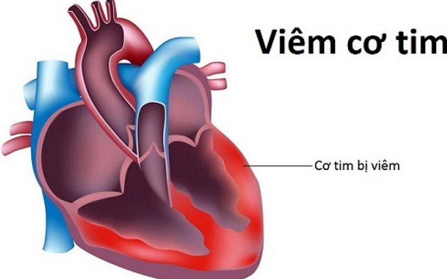 viem_co_tim-1 Viêm cơ tim