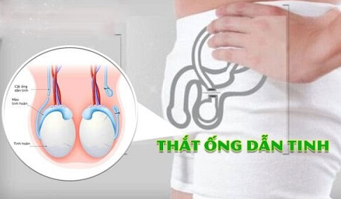 wzirqyso-that-ong-dan-tinh-1 Thắt ống dẫn tinh