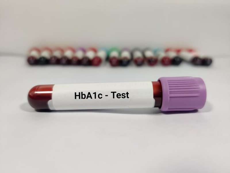 xet-nghiem-hba1c-1-1 Xét nghiệm HbA1c để tầm soát hoặc theo dõi bệnh lý tiểu đường