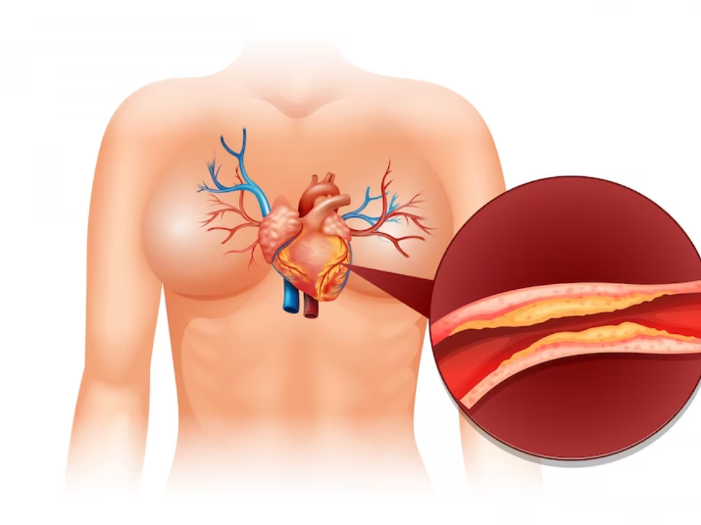 xo-vua-xong-mach Xơ vữa động mạch là một trong những nguyên nhân gây bệnh tim thiếu máu cục bộ