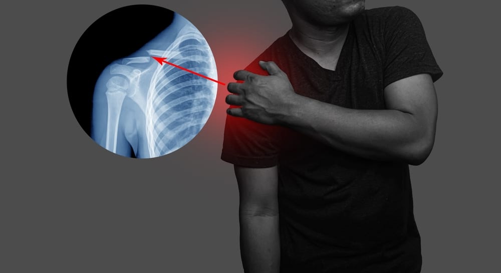 chấn thường xương đòn vai