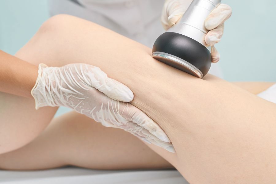 ydt0tzar-ran-da-2 Cách chữa rạn da bằng liệu pháp laser