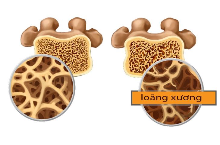z1lq9n5i-loang-xuong-1 Hình ảnh loãng xương