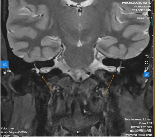 Hình ảnh chụp MRI đáy sọ xương đá: Tiền đình, ốc tai hai bên có hình thái và cấu trúc đồng nhất, không thấy bất thường - dị dạng